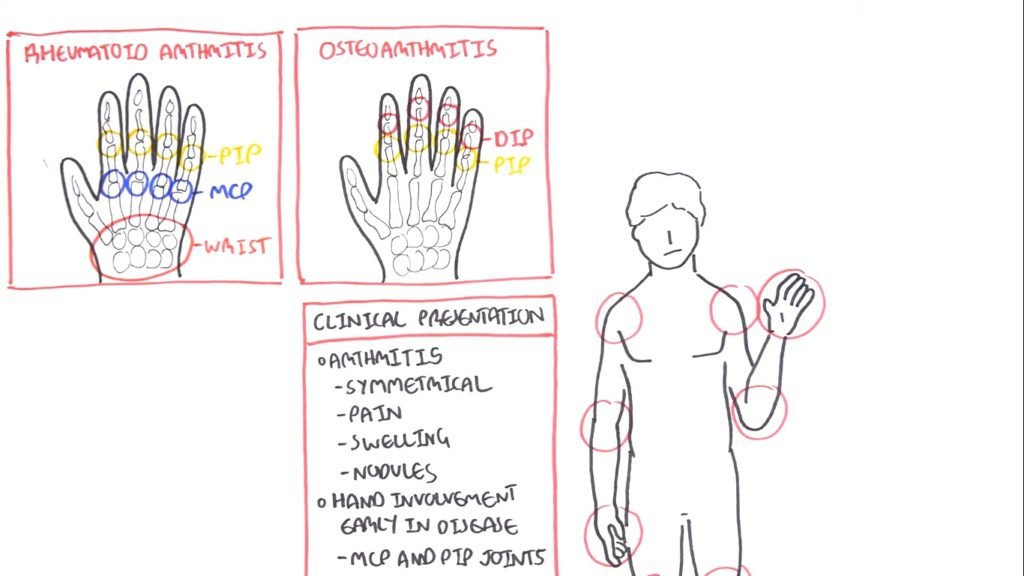 Rheumatoid Arthritis Pathophysiology hand