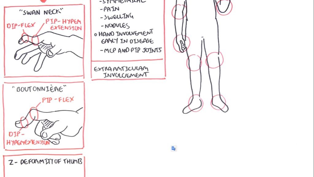 Rheumatoid Arthritis Pathophysiology anatomy 