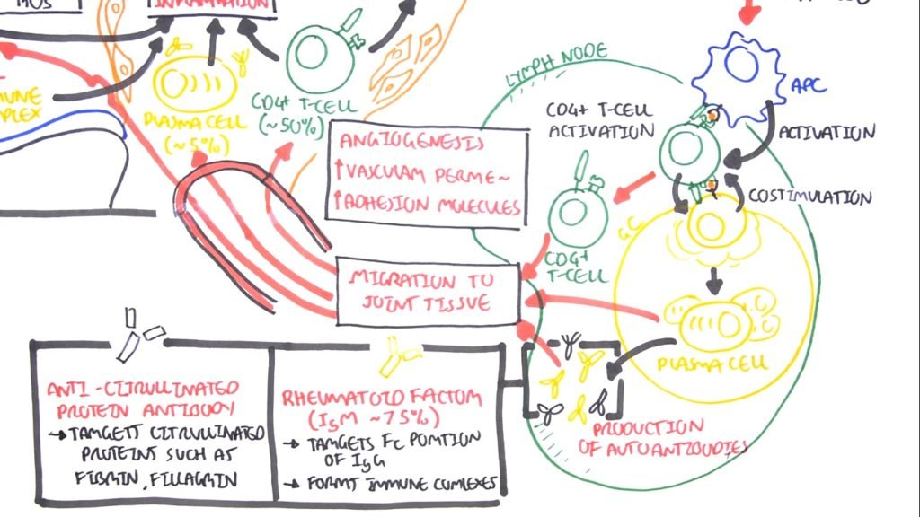 Rheumatoid Arthritis Pathophysiology diagram