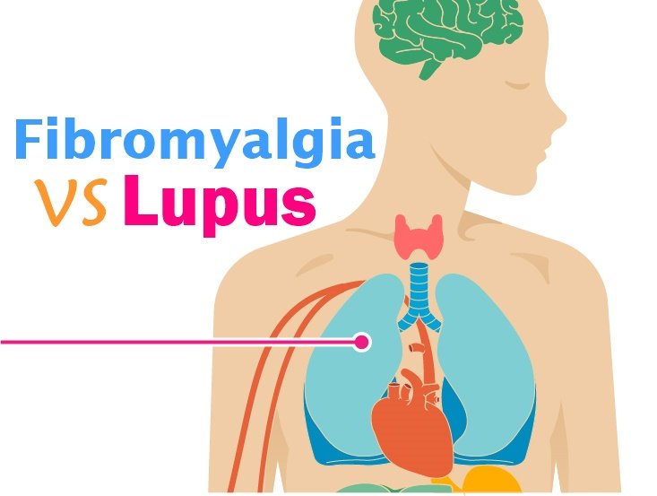 Read more about the article Fibromyalgia and Lupus: Differences, Similarities