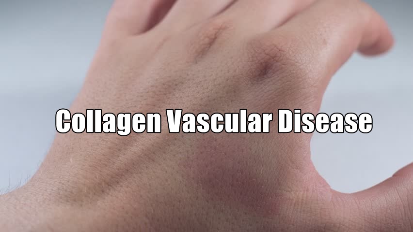 You are currently viewing Collagen Vascular Disease Basics and Symptoms