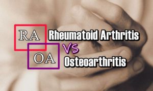 Read more about the article Rheumatoid Arthritis vs Osteoarthritis: Differences, Similarities