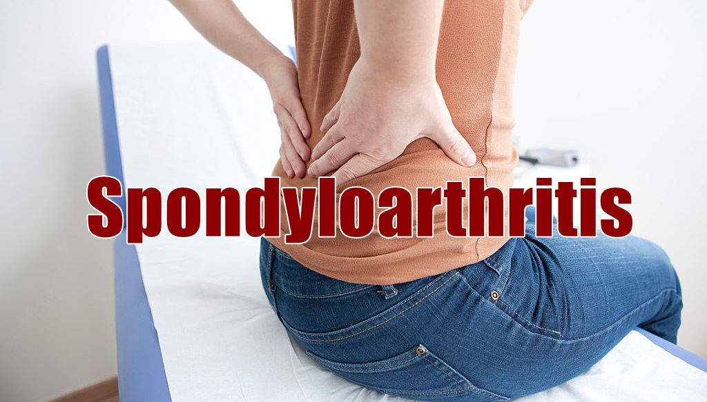 You are currently viewing Spondyloarthritis and Rheumatological Diseases